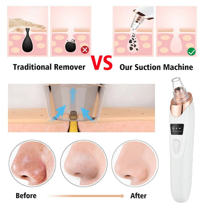 Vacuum Suction Acne Pimple Blackhead Remover